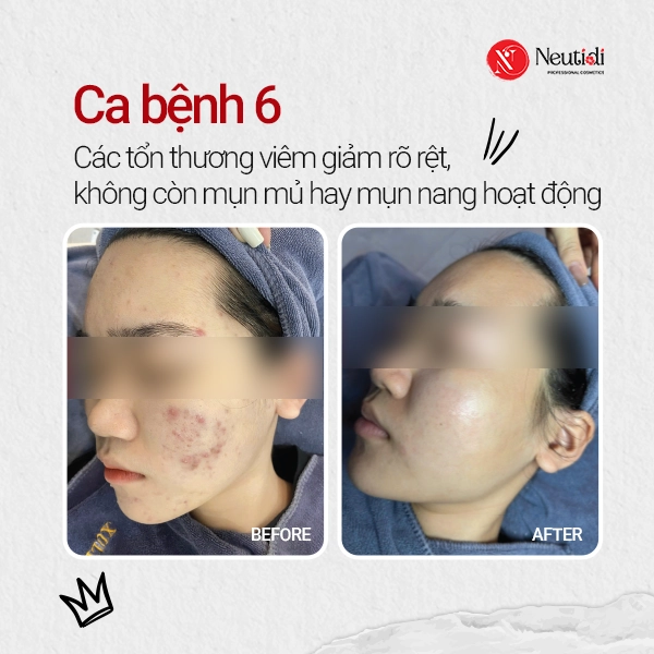 Ca bệnh 6