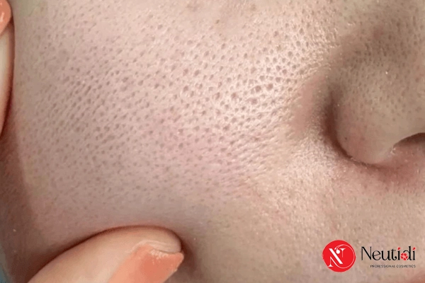 Những nguyên nhân khiến lỗ chân lông bị giãn to