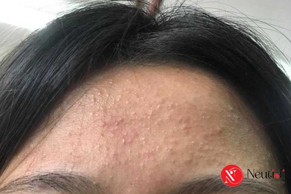 Dấu hiệu da mặt bị bít tắc lỗ chân lông & 5 bước xử lý hiệu quả 3 Những nguyên nhân gây bít tắc lỗ chân lông