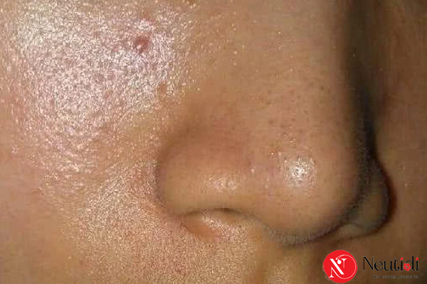 Da Dầu Nhờn Là Gì? Hiểu Đúng Để Không Chăm Sai 3 Những nguyên nhân khiến da đổ dầu