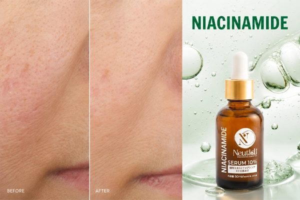 Niacinamide dành cho da bị lỗ chân lông to