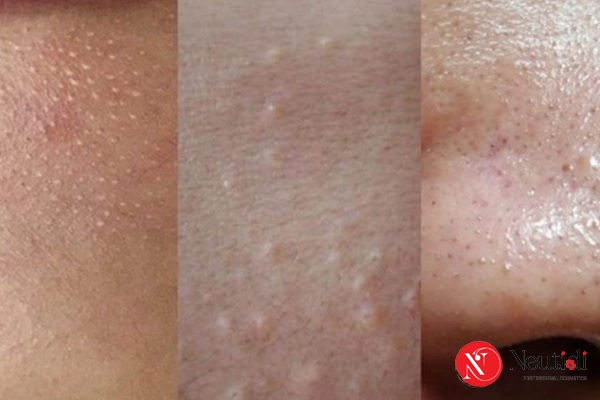 Phân biệt mụn ẩn với các loại mụn khác