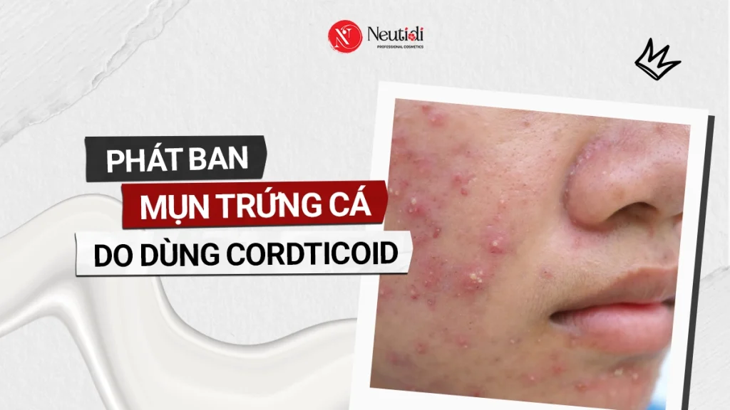Phát ban mụn trứng cá do dùng corticoid