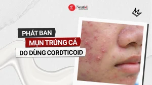 Phát ban mụn trứng cá do dùng corticoid