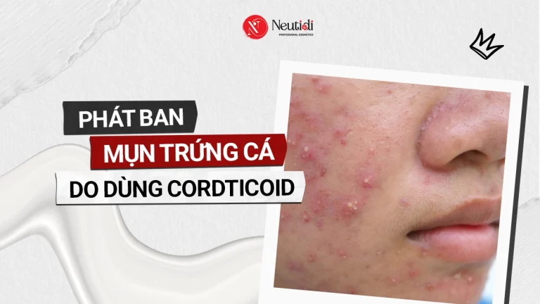 Phát ban mụn trứng cá do dùng corticoid