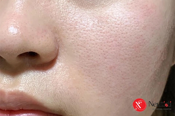 Retinol là hoạt chất hỗ trợ thu gọn lỗ chân lông to