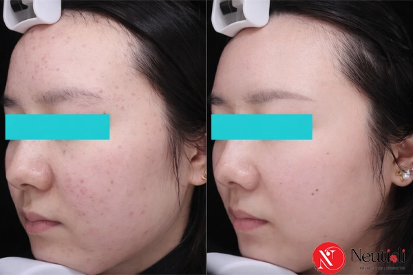 Áp dụng routine tối giản từ Neutidi để giảm mụn trứng cá