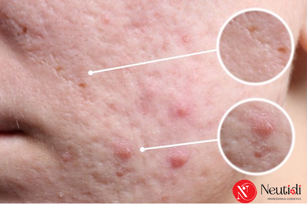 Hậu quả - sẹo sau mụn trứng cá
