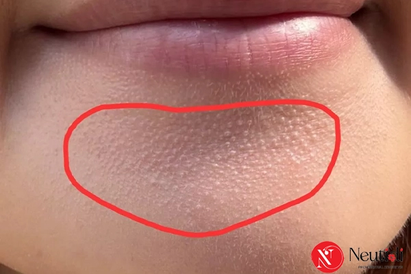 Ảnh sợi bã nhờn