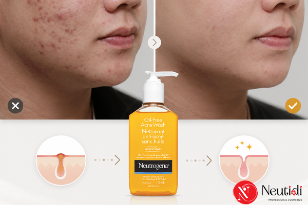 Top 6 sữa rửa mặt trị mụn cho nam 2026: Đừng chọn bừa kẻo da tệ hơn 4 Neutrogena Oil-Free Acne Wash - sữa rửa mặt giảm mụn cho nam