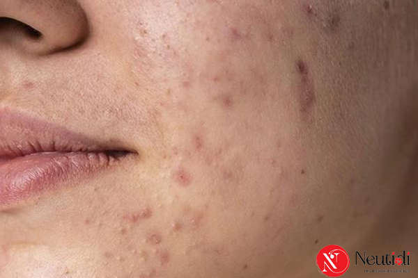 Vết thâm xuất hiện sau mụn trứng cá