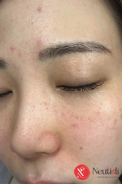 Cách ngăn ngừa mụn trứng cá: Bôi gì? Tránh gì để mụn không mọc lại? 7 Tránh các thói quen xấu khiến mụn mãi không hết