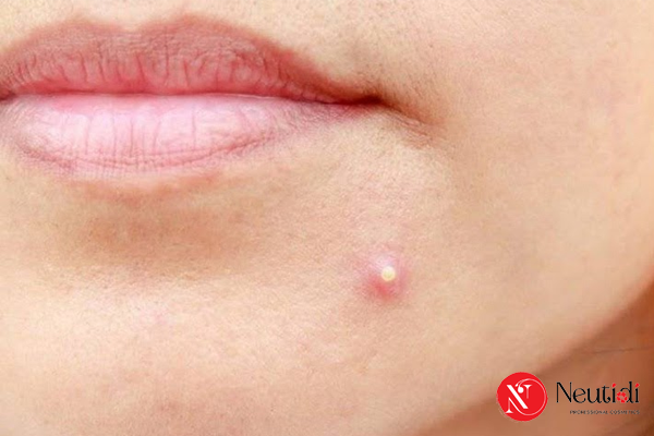 Mụn đầu trắng: Nguyên nhân, nhận biết & cách trị hiệu quả 4 Cách trị mụn đầu trắng nhẹ, ít