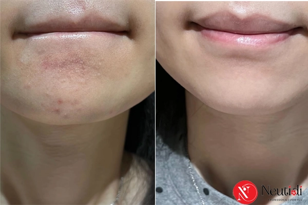 Làn da đã được kiểm soát bã nhờn sau khi dùng Neutidi