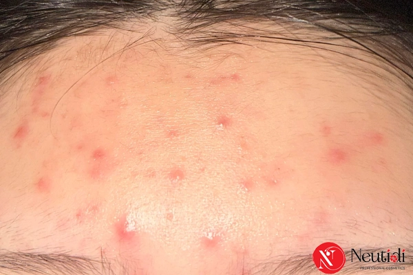 chú ý vệ sinh tóc và vùng da liền kề