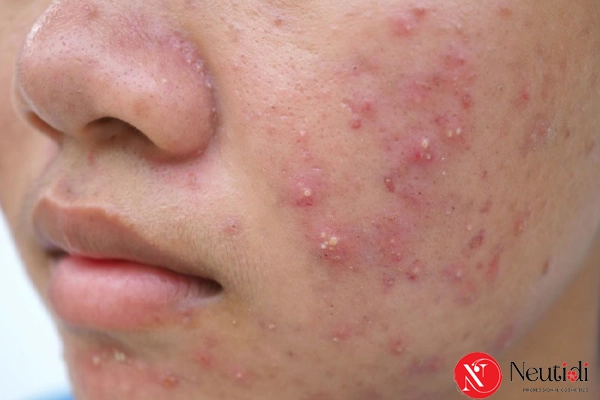 Hướng xử lý cho tình trạng nổi mụn trứng cá do corticoid