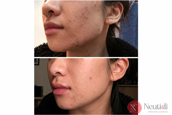 Adapalene có đẩy mụn không? 6 bước xử lý khi dùng adapalene bị đẩy mụn 4 Adapalene đẩy mụn bao lâu thì hết?
