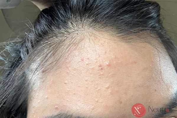 Adapalene có đẩy mụn không? 6 bước xử lý khi dùng adapalene bị đẩy mụn 5 Cách xử lý khi dùng adapalene bị đẩy mụn