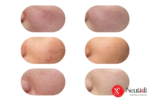 Yếu tố ảnh hưởng đến thời gian phục hồi của mụn trứng cá