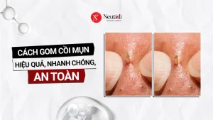 Cách gom cồi mụn nhanh, hiệu quả