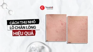 Cách thu nhỏ lỗ chân lông ở mặt theo từng vùng mũi, má, trán và cằm 17 Cách thu nhỏ lỗ chân lông cho da mặt hiệu quả
