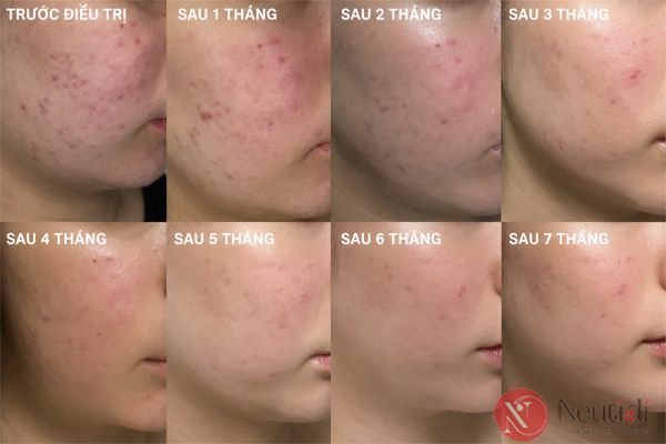Cách chăm sóc da bị bùng mụn khi dùng iso