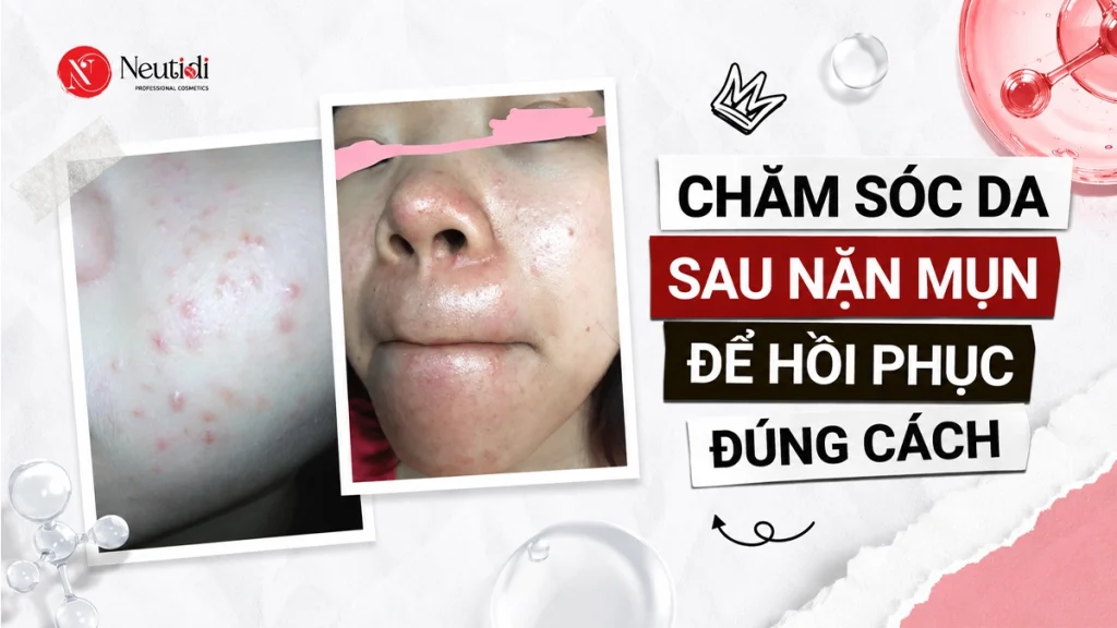Cách chăm sóc da sau khi nặn mụn hiệu quả phòng ngừa thâm, viêm, tăng sắc tố