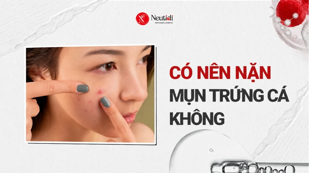 Có nên nặn mụn trứng cá không? Loại nào có thể nặn? 1 Có nên nặn mụn trứng cá không?