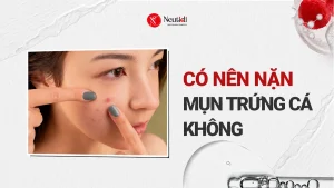 Có nên nặn mụn trứng cá không? Loại nào có thể nặn? 16 Có nên nặn mụn trứng cá không?