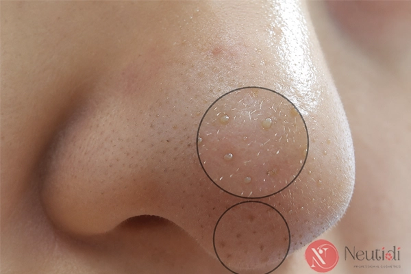 Cồi mụn là gì?