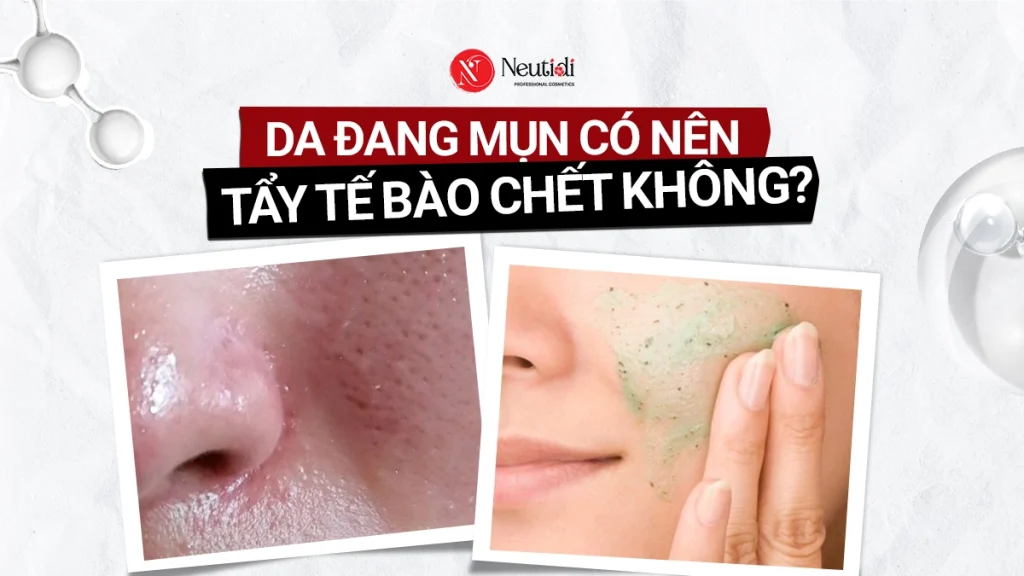 Da mụn có nên tẩy tế bào chết? 4 bước thực hiện đúng chuẩn 1 Da mụn có nên tẩy tế bào chết