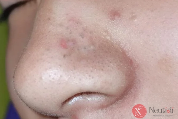 Da mụn có nên tẩy tế bào chết? 4 bước thực hiện đúng chuẩn 2 Da đang mụn có nên tẩy tế bào chết hay không?