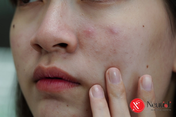 Da dầu mụn có cần BHA không?
