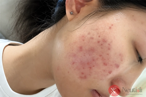 Bùng mụn trong quá trình sử dụng isotretinoin