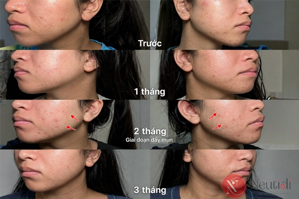 Adapalene có đẩy mụn không? 6 bước xử lý khi dùng adapalene bị đẩy mụn 3 Đẩy mụn do dùng adapalene kéo dài bao lâu?