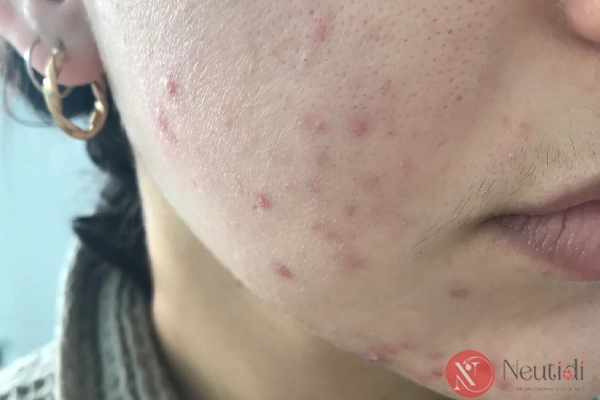 Adapalene có đẩy mụn không? 6 bước xử lý khi dùng adapalene bị đẩy mụn 2 Nhận diện tình trạng đẩy mụn do adapalene