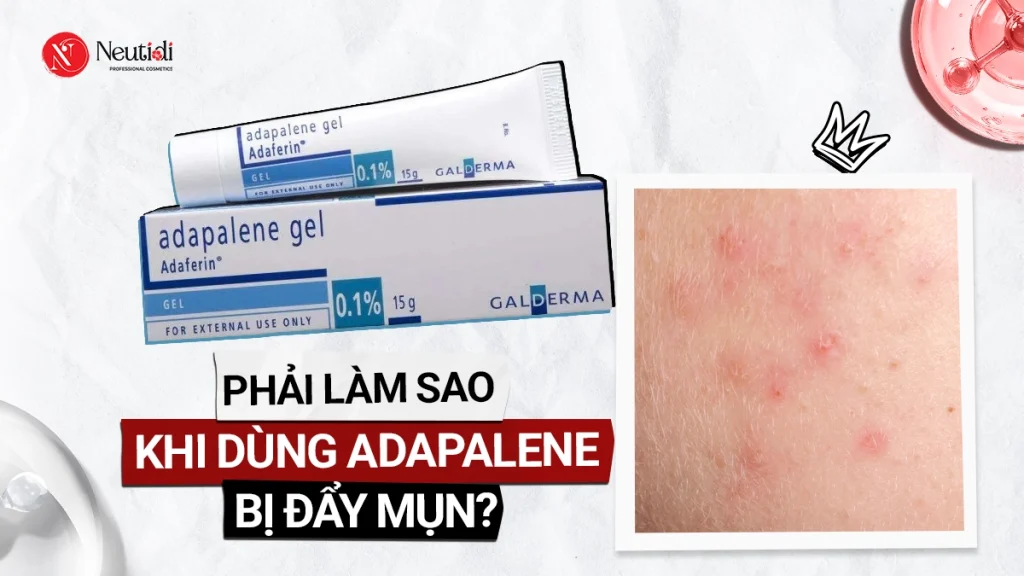 Adapalene có đẩy mụn không? 6 bước xử lý khi dùng adapalene bị đẩy mụn 1 Adapalane có đẩy mụn không?