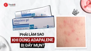 Adapalene có đẩy mụn không? 6 bước xử lý khi dùng adapalene bị đẩy mụn 16 Adapalane có đẩy mụn không?