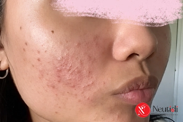 Dùng dầu tẩy trang bị lên mụn?