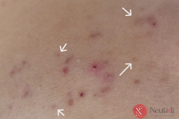 Hậu quả khi không chăm sóc da sau khi nặn mụn