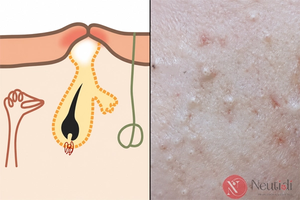Hình ảnh mụn ẩn