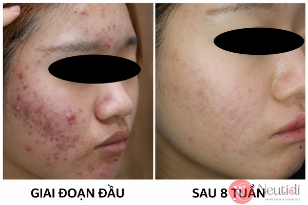 Bùng mụn khi uống isotretinoin sẽ kéo dài khảong 8 tuần/2 tháng
