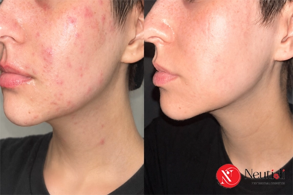 Dấu hiệu để nhận biết mụn trứng cá đang phục hồi