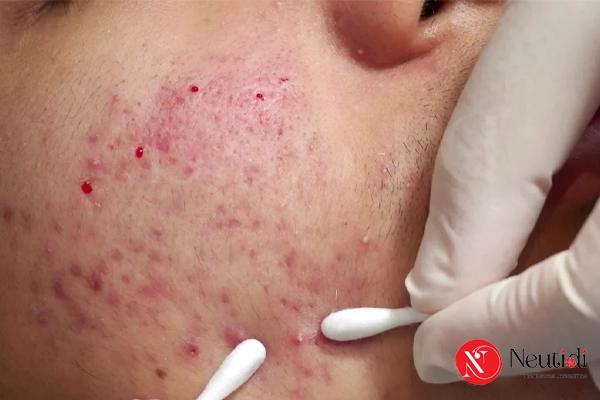 Có nên nặn mụn trứng cá không? Loại nào có thể nặn? 6 Bác sĩ lấy nhân mụn trứng cá