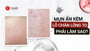 Mụn ẩn kèm lỗ chân lông to