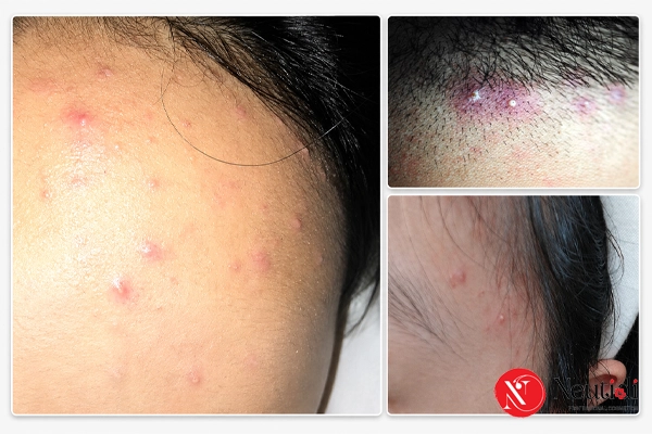 Nổi mụn ở vùng trán gần đường chân tóc là do đâu?