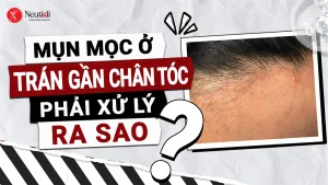 Mụn mọc ở tránh gần đường chân tóc