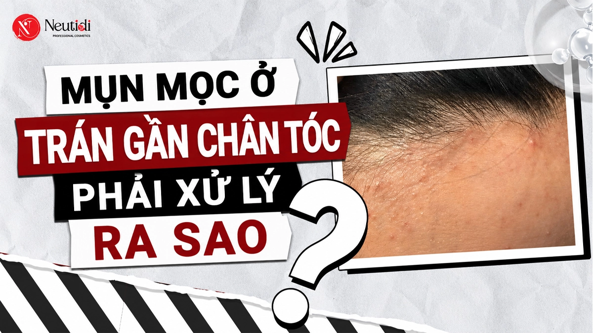 Phân biệt 4 loại mụn mọc ở trán gần chân tóc & Cách xử lý 17 Mụn mọc ở tránh gần đường chân tóc