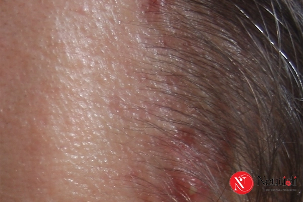 Phân biệt mụn ở trán đường chân tóc do ma sát