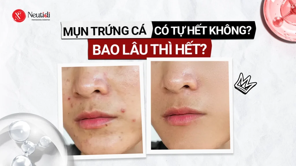 Mụn trứng cá bao lâu thì hết?